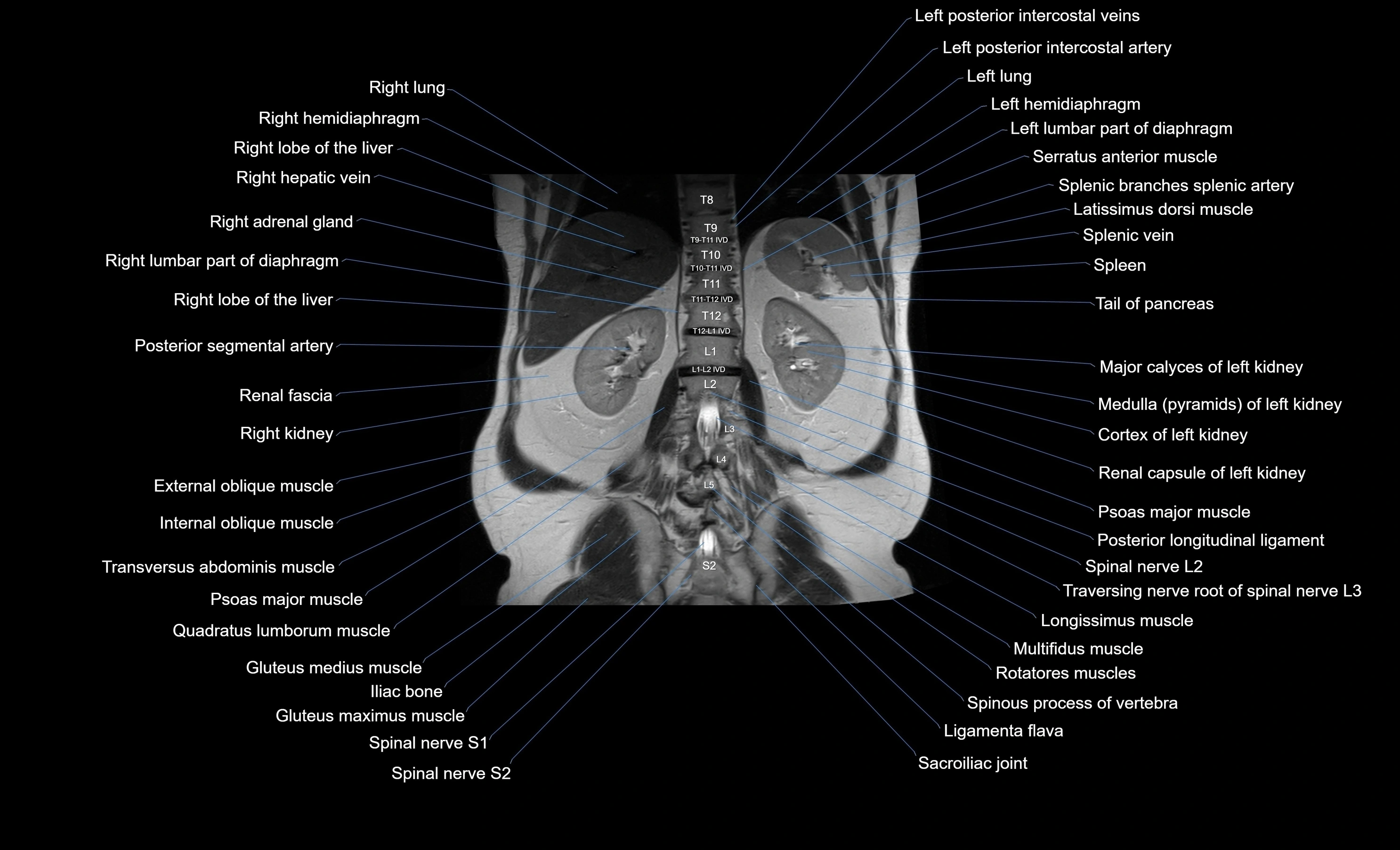 MRI Abdomen coronal labelled cross sectional anatomy radiology  image-img-00001-00042.webp